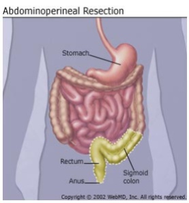 abdominoperineal_resection